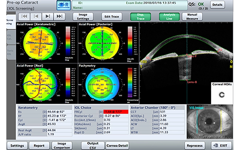 Cataract Pre-op