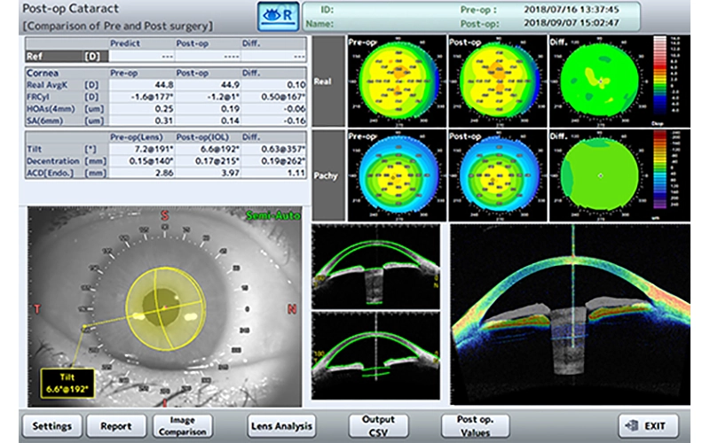 Cataract Post-op