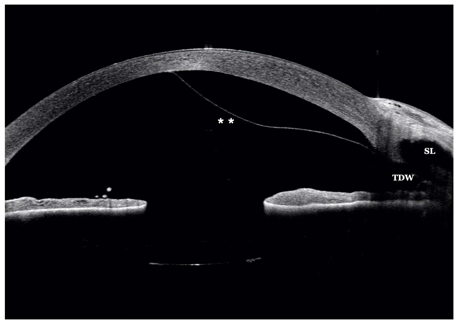 Descemet’s Detachment – Rare Post-NPGS Complication