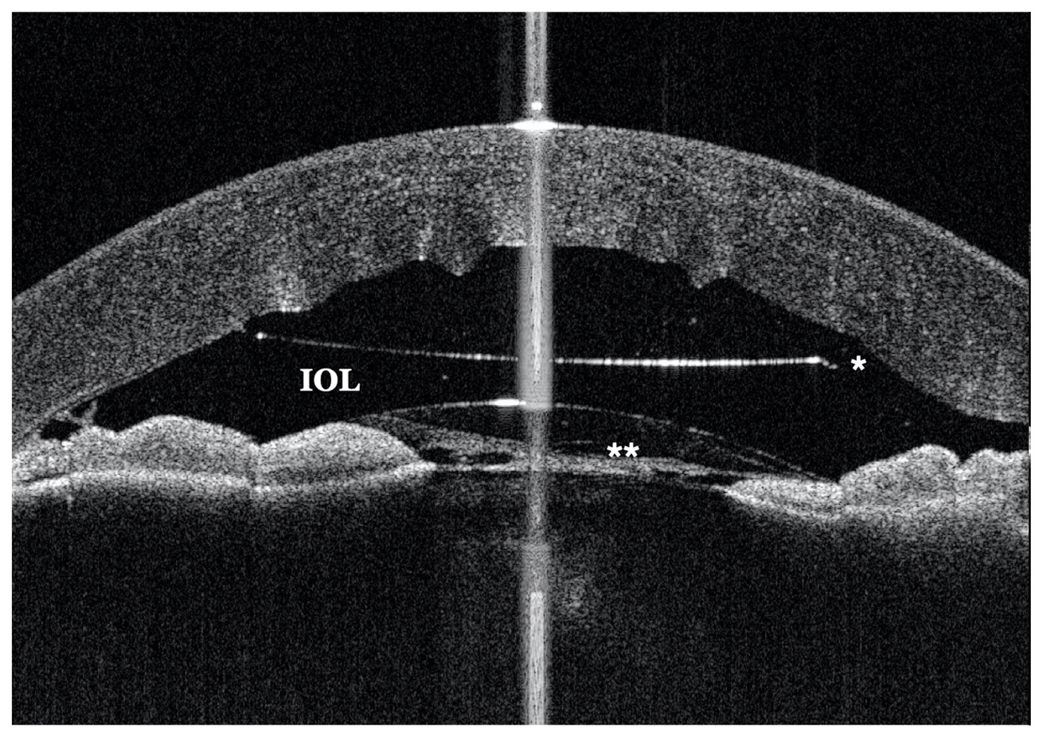 Post-Surgery Corneal Edema and Athalamia in Glaucoma 