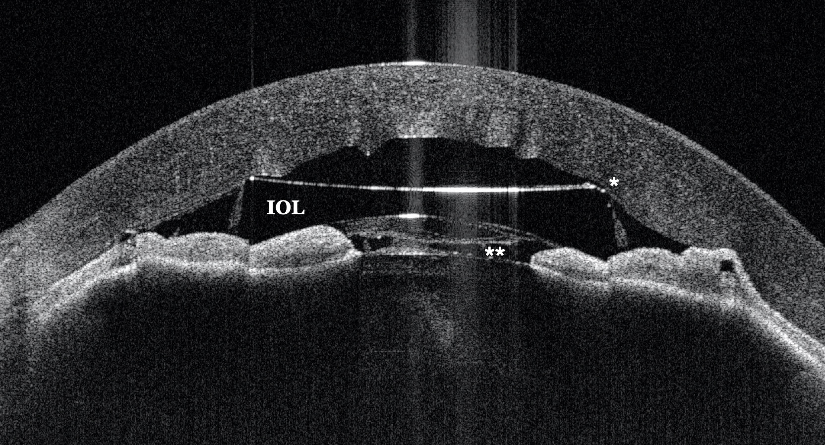 Figure 1: Corneal edema and athalamia
