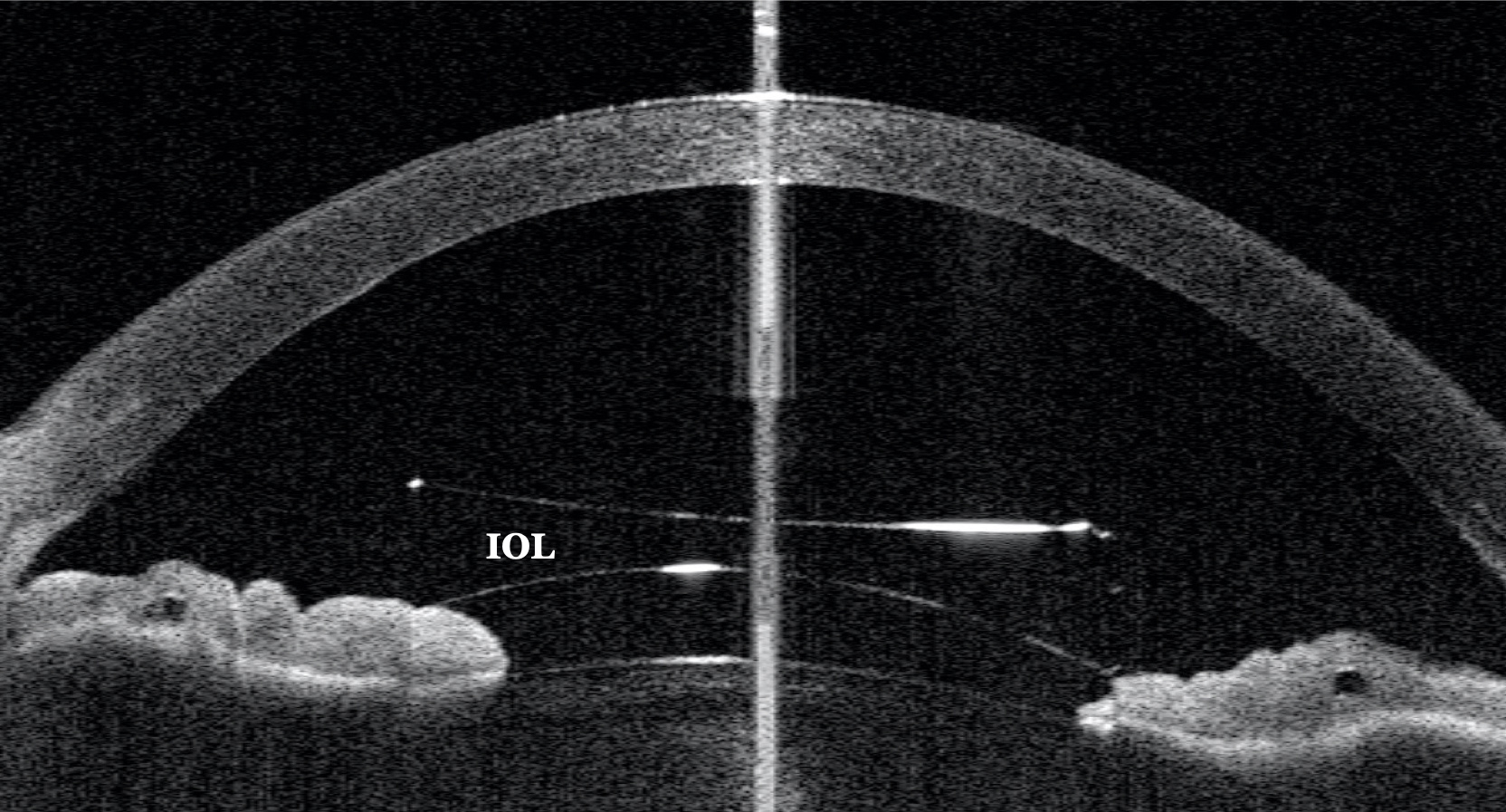Figure 3: Resolution after 3 days, with a clear cornea and a deep anterior chamber