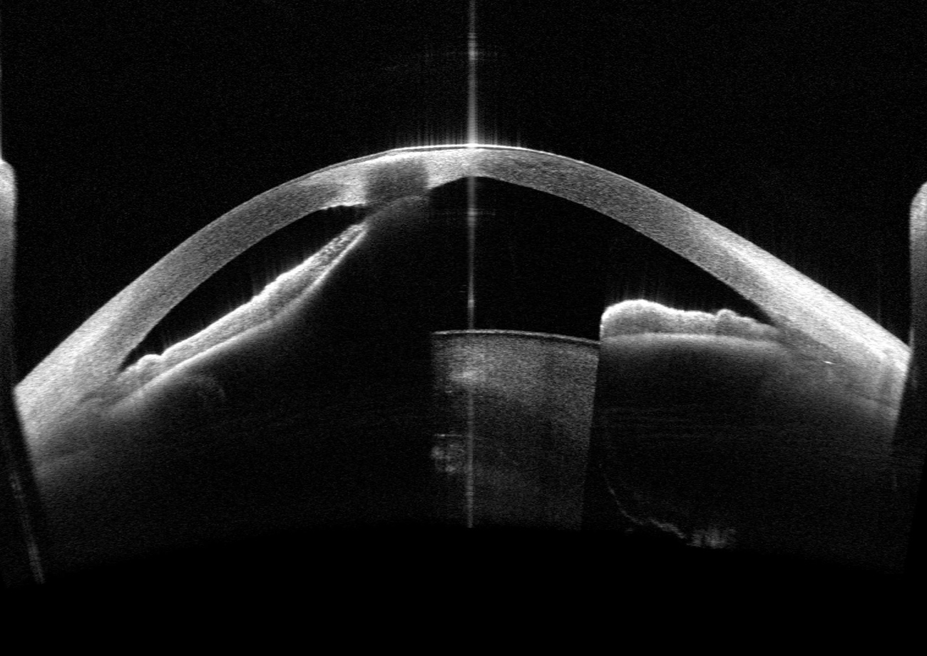 Peters Anomaly