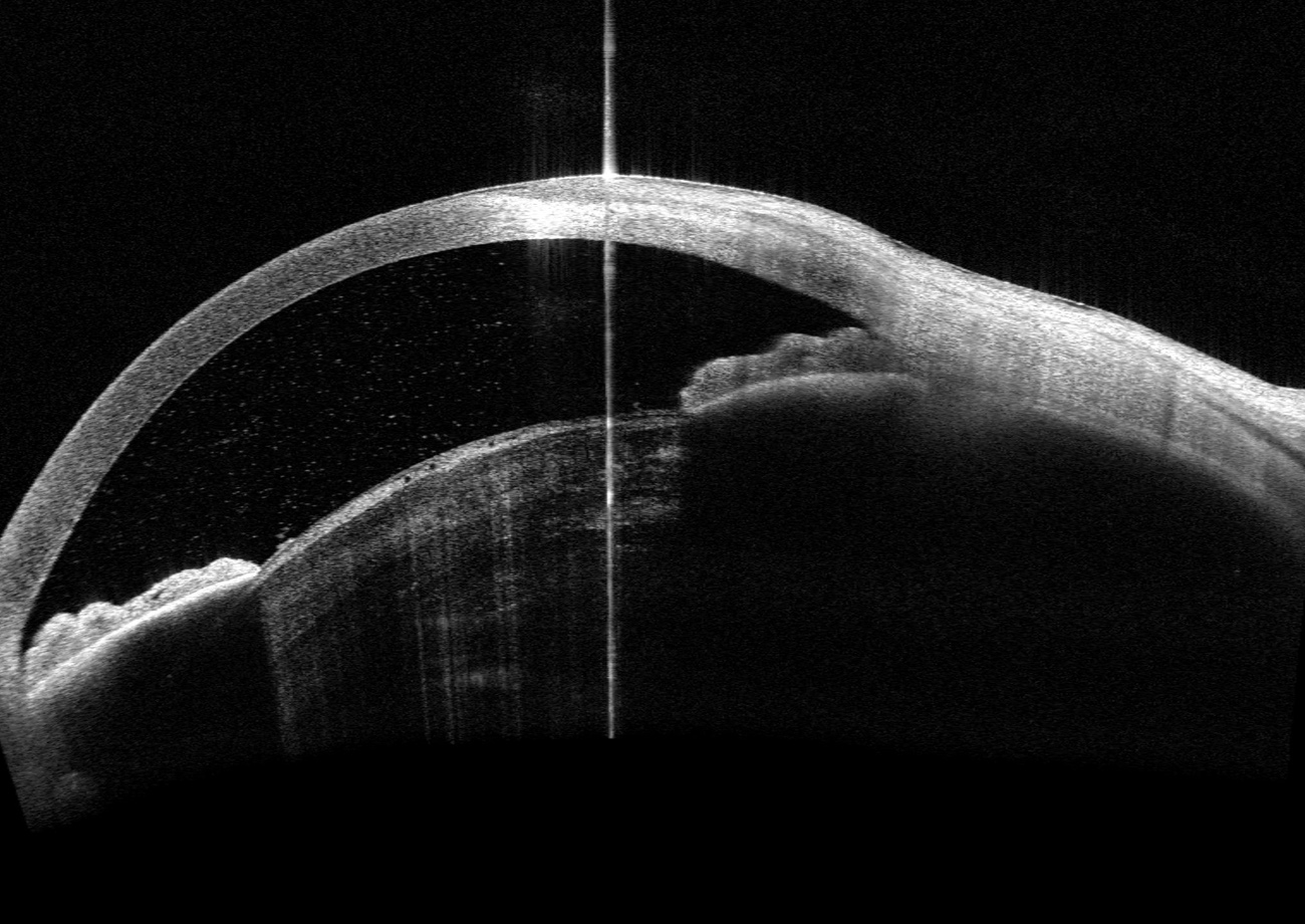 Phacolytic Glaucoma 