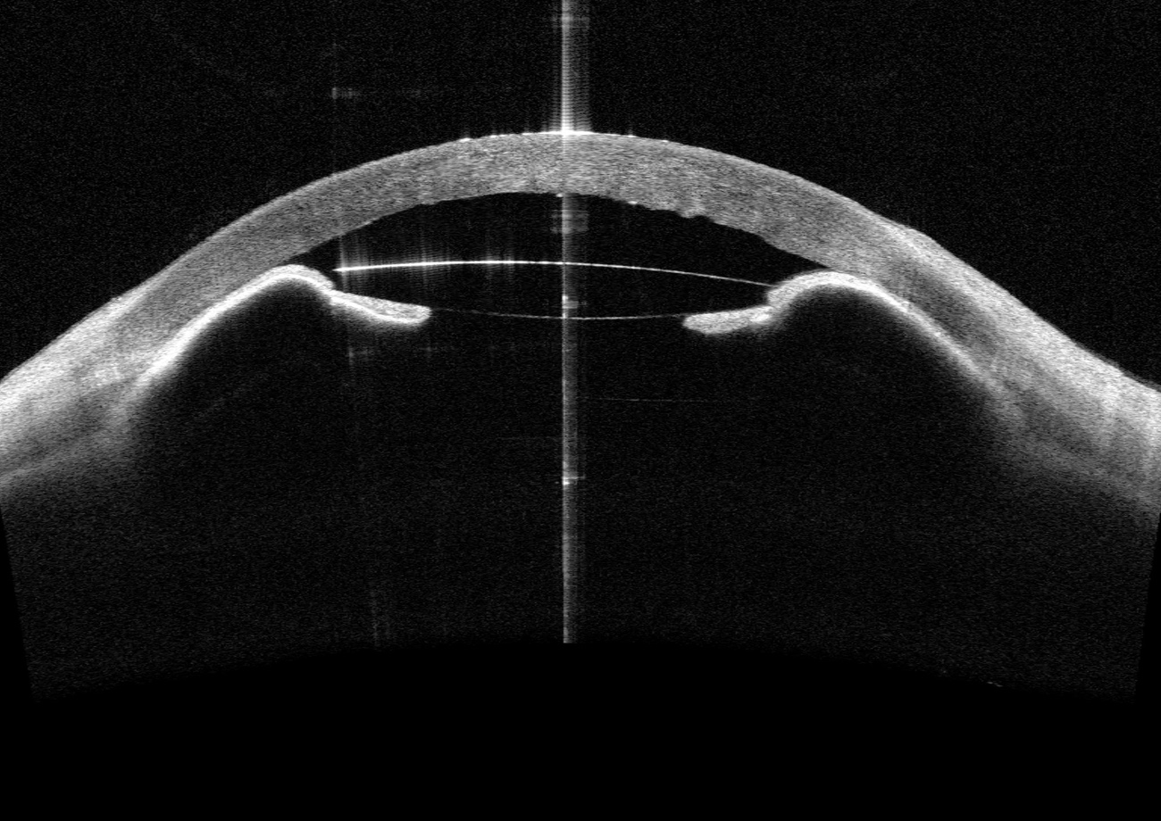 AC-IOL and Peripheral Iridectomy Not Functioning