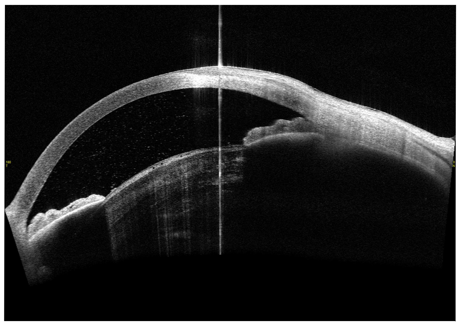 Phacolytic Glaucoma 