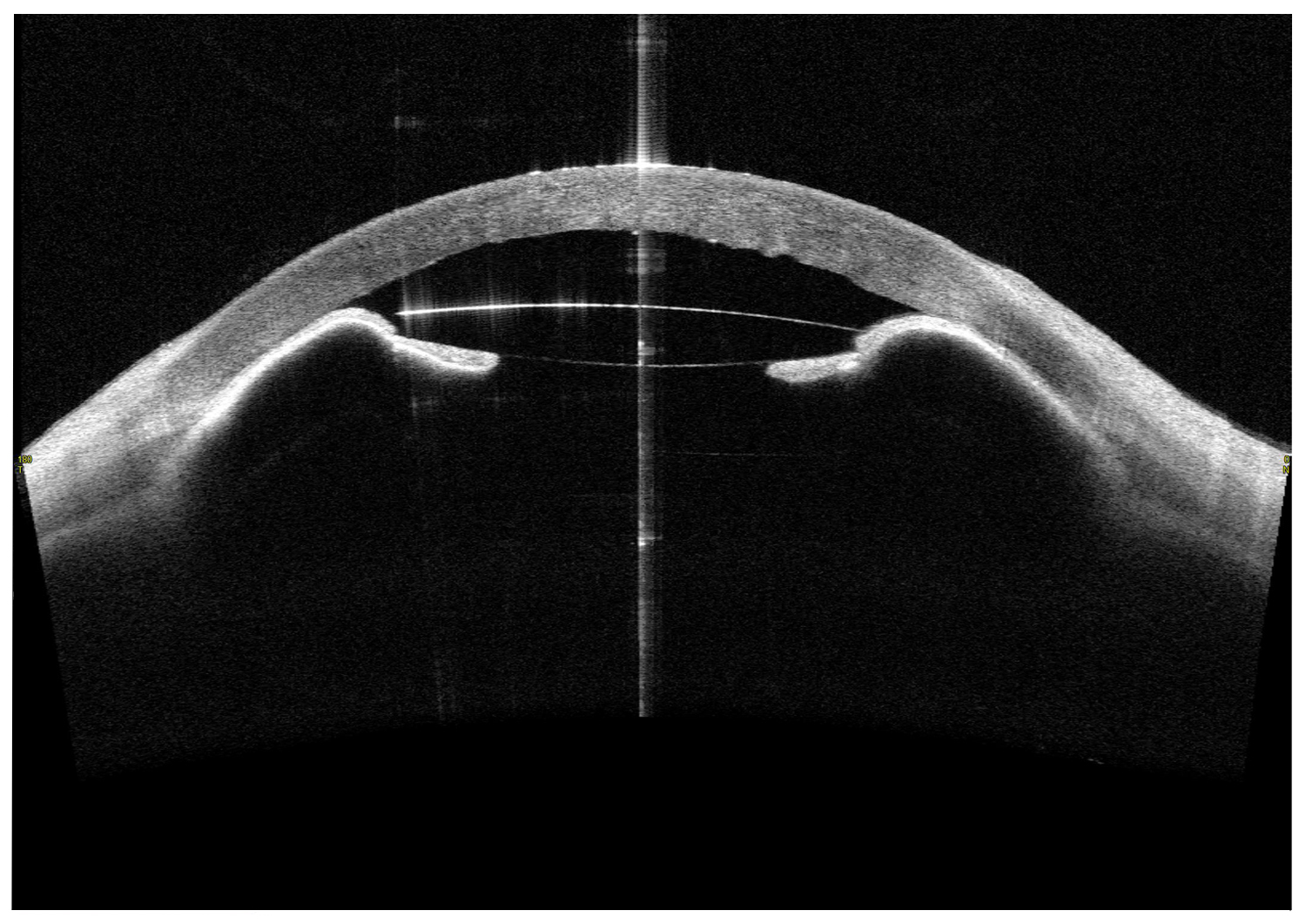 AC-IOL and Peripheral Iridectomy Not Functioning