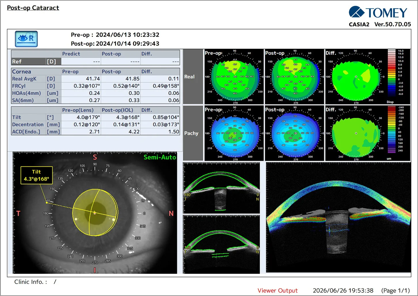 CASIA2 in Cataract Surgery: From Preoperative Planning to Postoperative Confirmation
