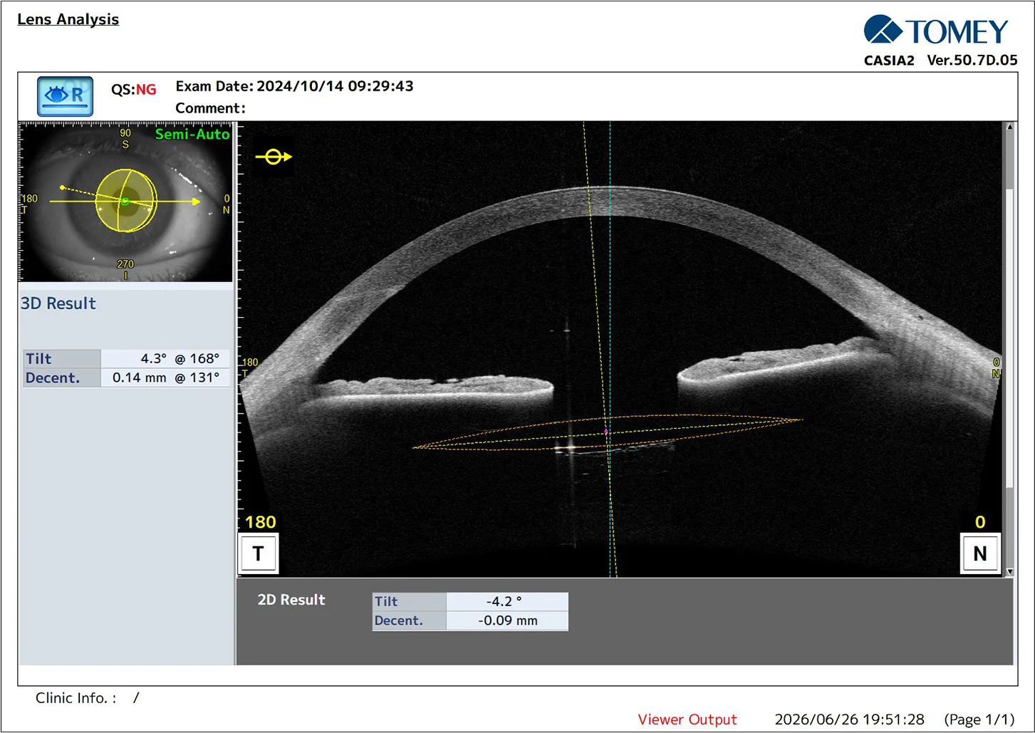 Postoperative IOL Analysis