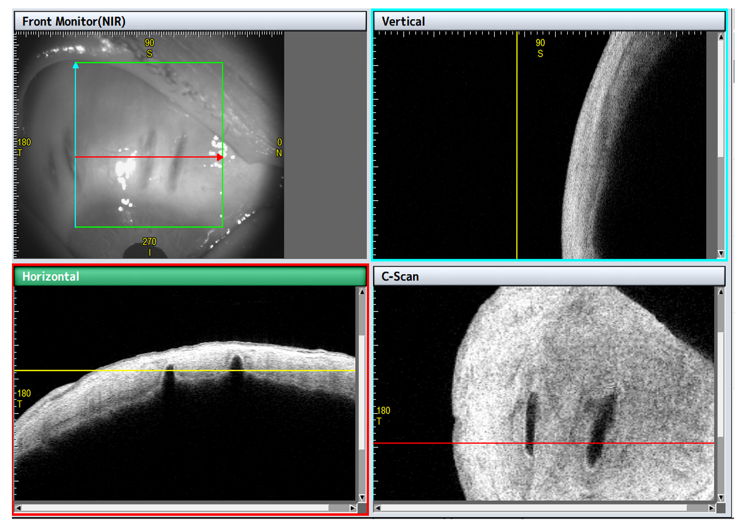 LAPR (Laser Presbyopia Reversal)