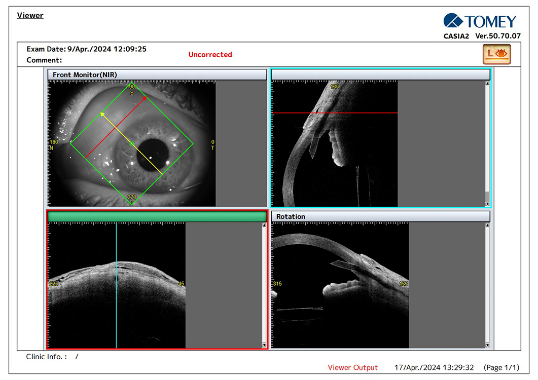 Preserflo® Implant