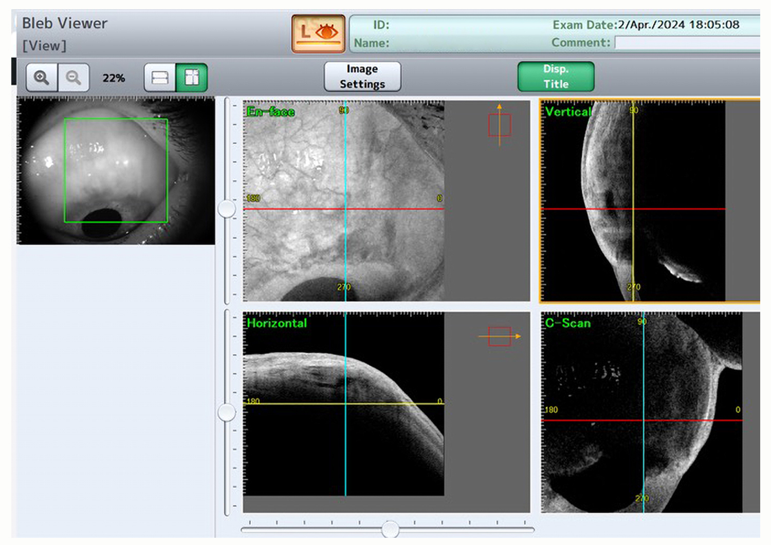 Assessing ESNOPER V2000 Implant Permeability