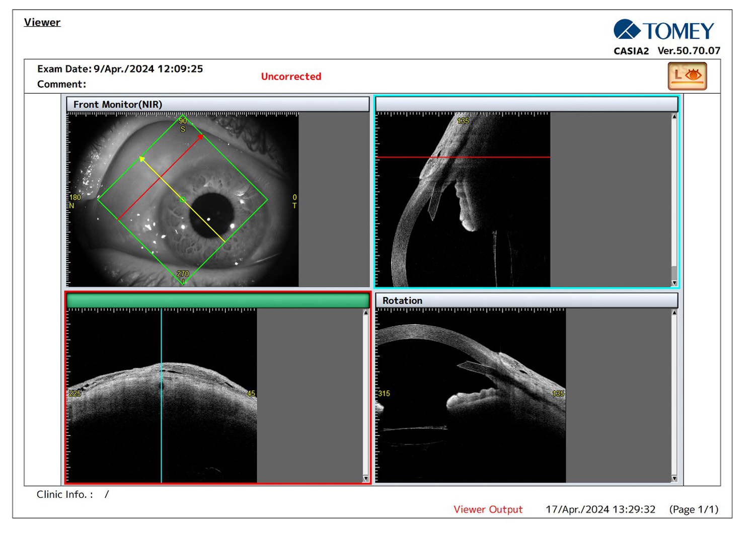 Evaluating Preserflo® Implant Efficiency