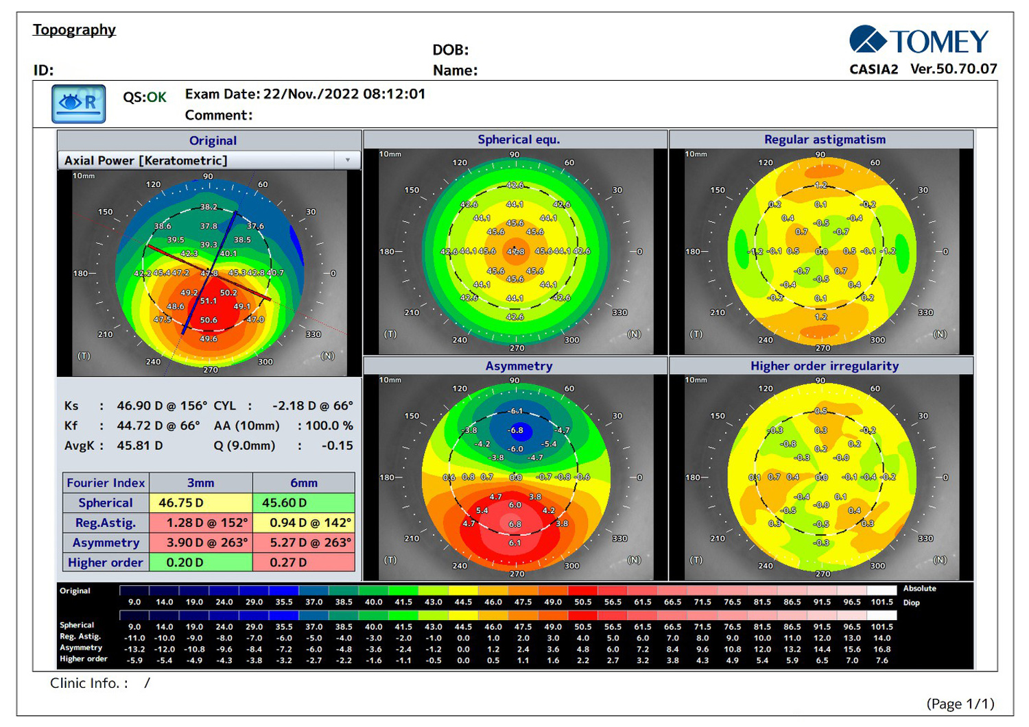 The First Asymmetric Ring AS6-300/150° Implantation in Keratoconus