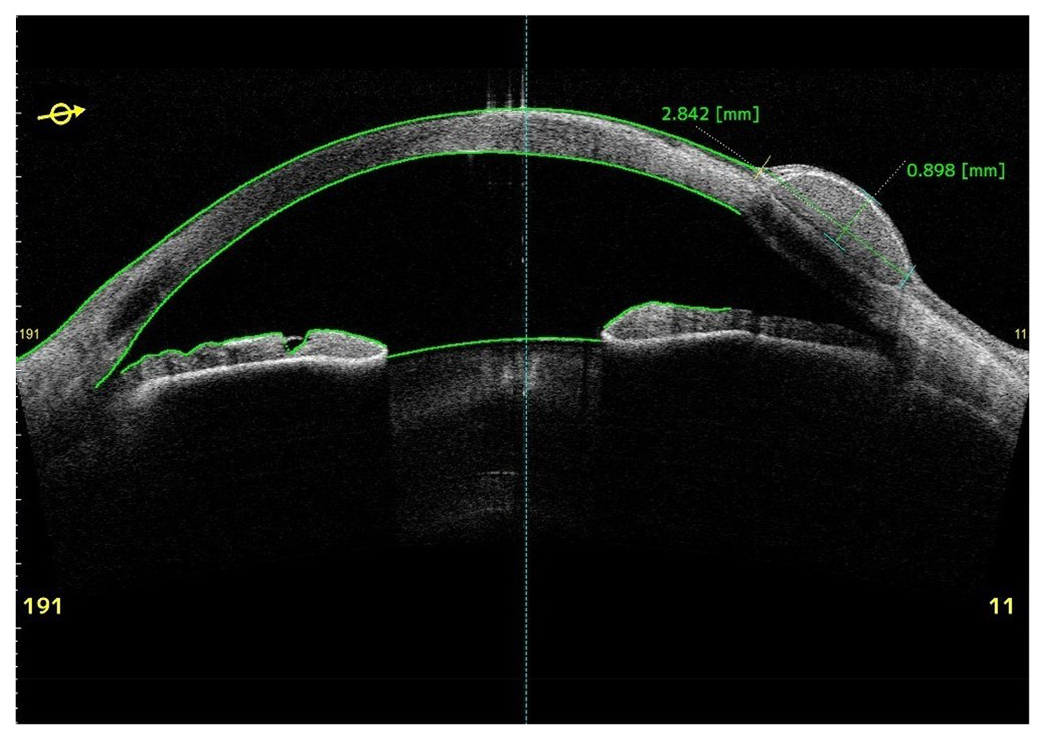 Cyst at the Limbus