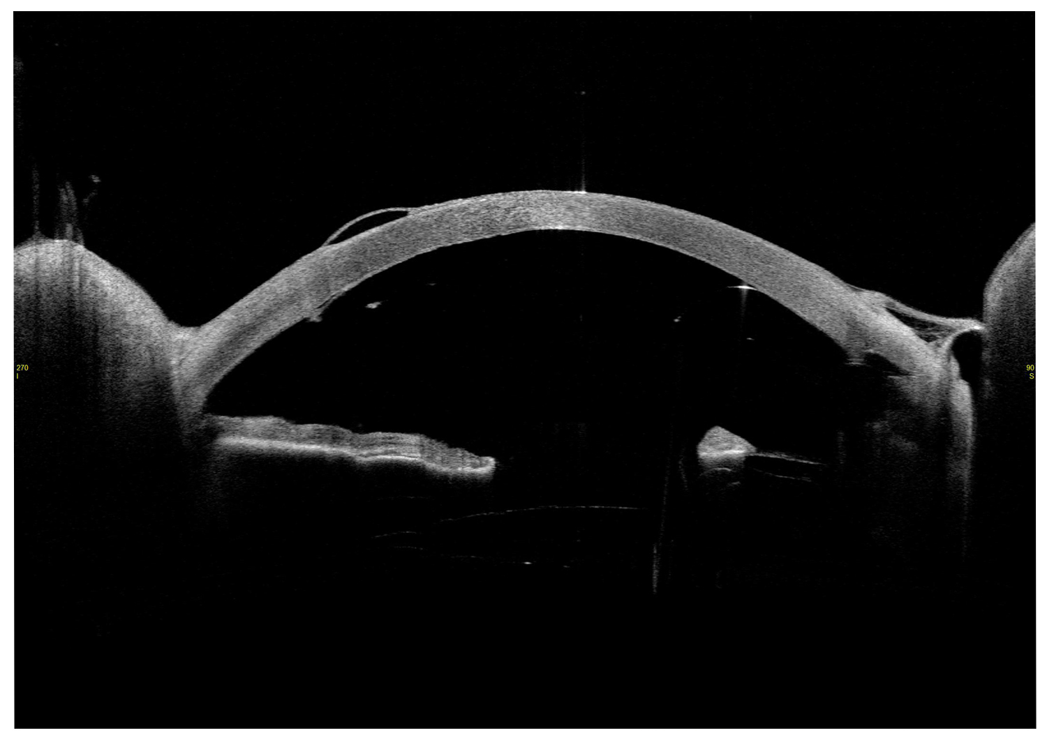 Descemet’s Membrane Detachment (Pre-Op and Post-Op)