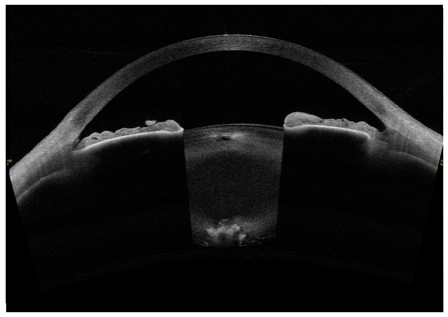 Posterior Polar Cataract – Capsular Involvement
