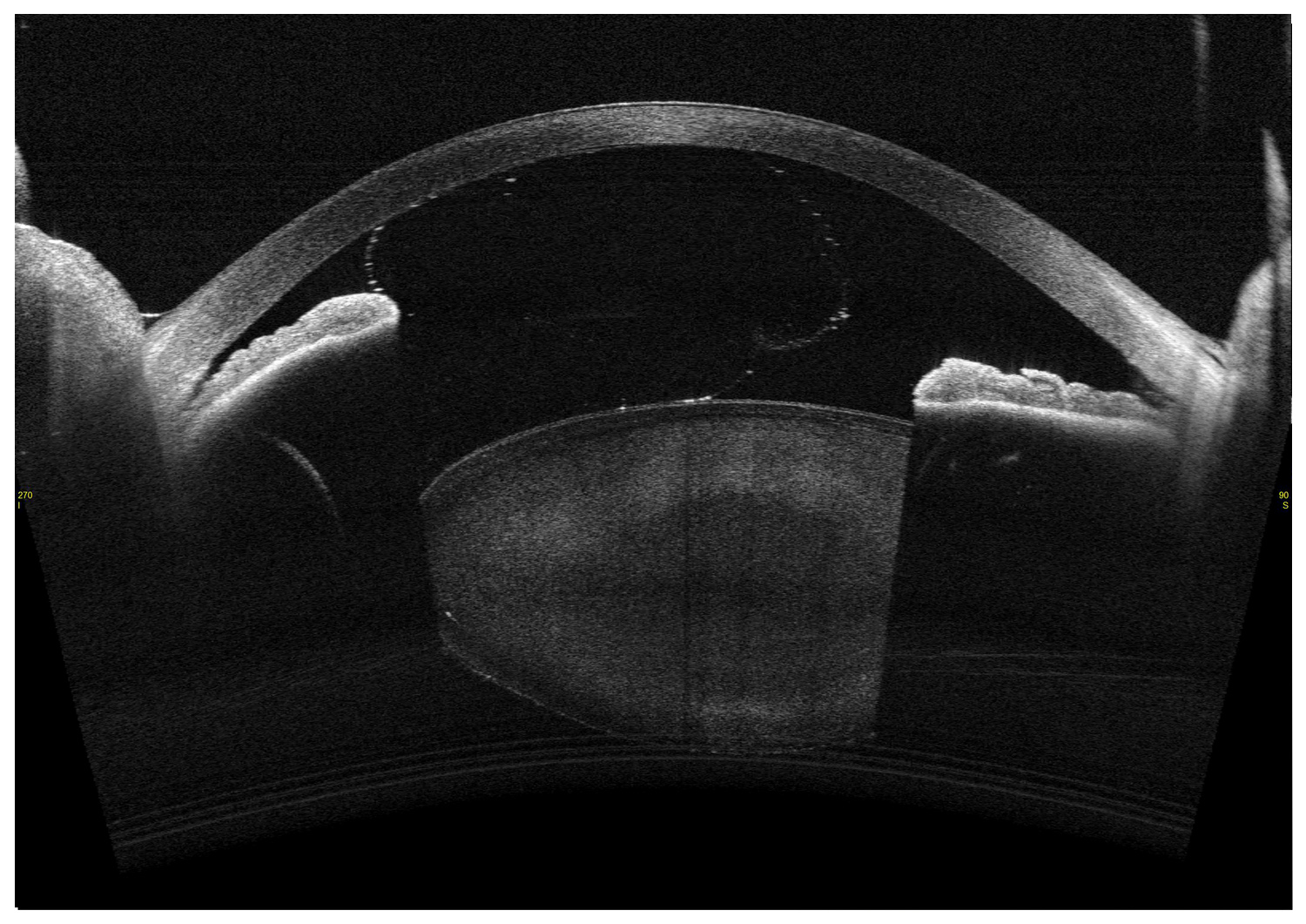 Subluxed Lens and Vitreous Prolapse Following Trauma