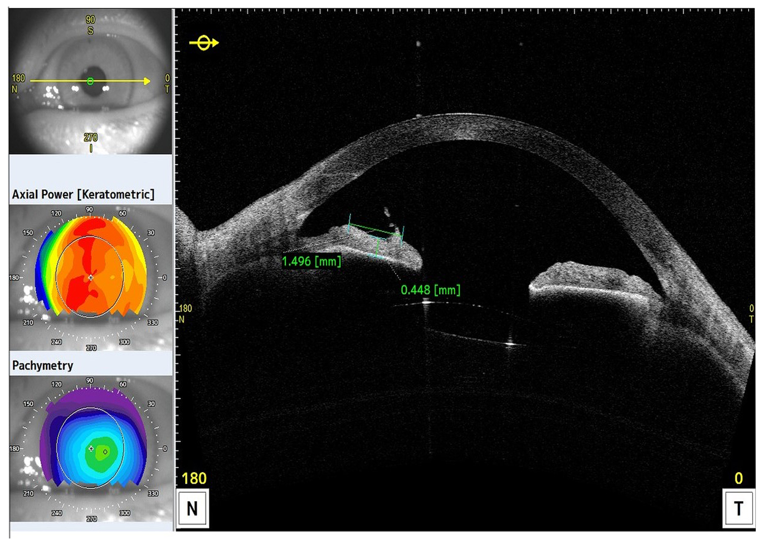 Iris Incarceration Following Difficult Cataract Surgery