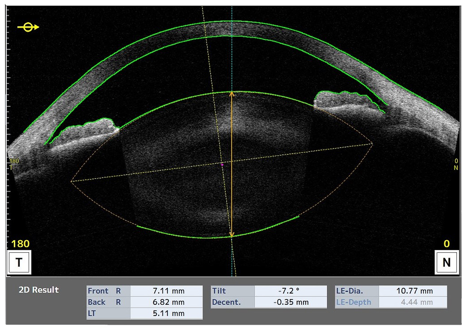 Re-rotation of a Toric IOL