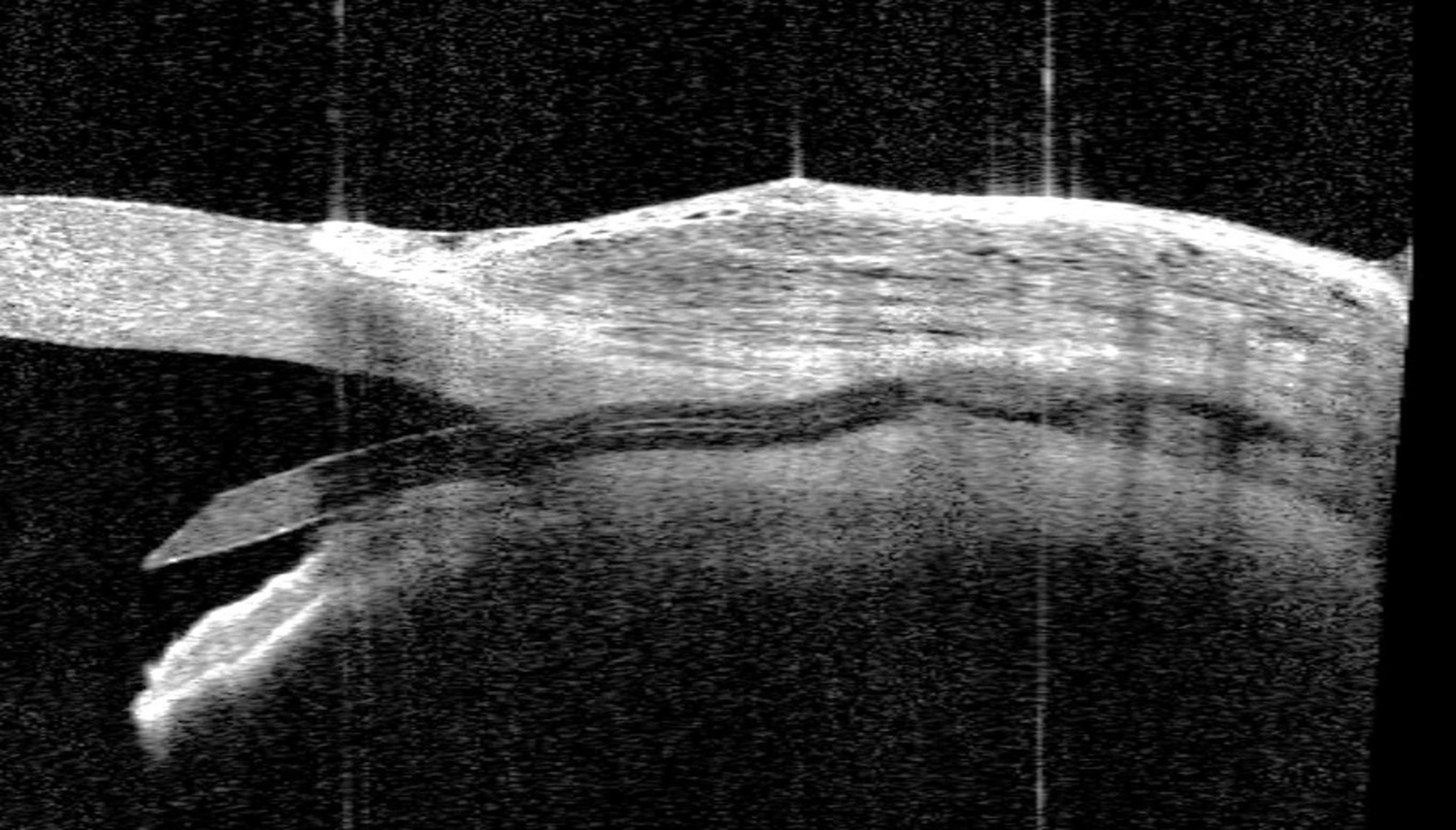 CASIA2 cross-sectional image using “bleb” mode