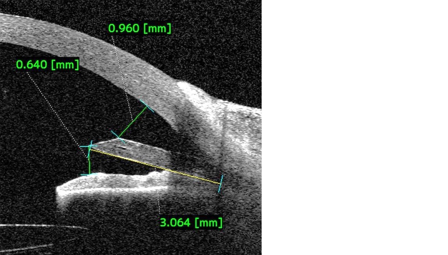 CASIA2 anterior chamber cross-sectional image