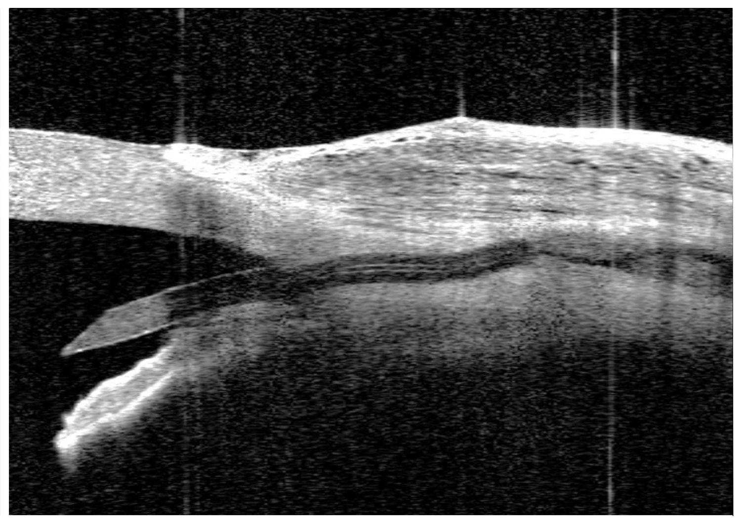 Preserflo® Microshunt* Glaucoma Surgery  (Post-op 4 weeks)