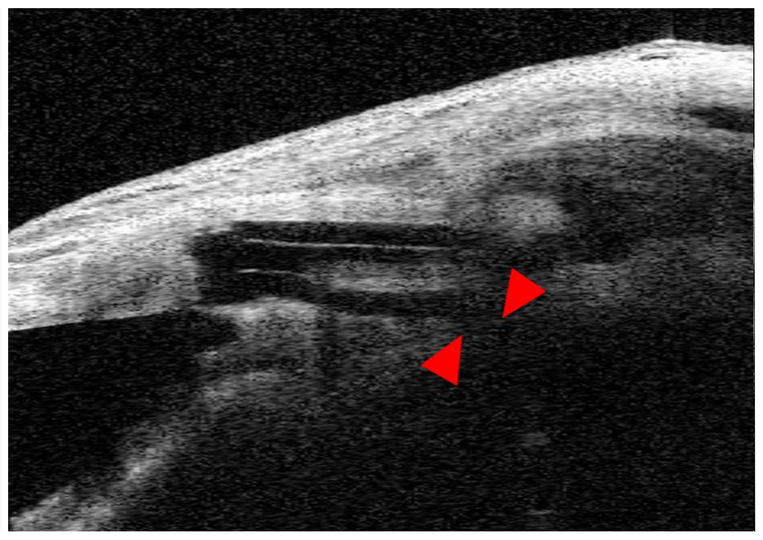 Non-penetrating Deep Sclerectomy (NPDS): Post-op 3 months and Post-op 1 week