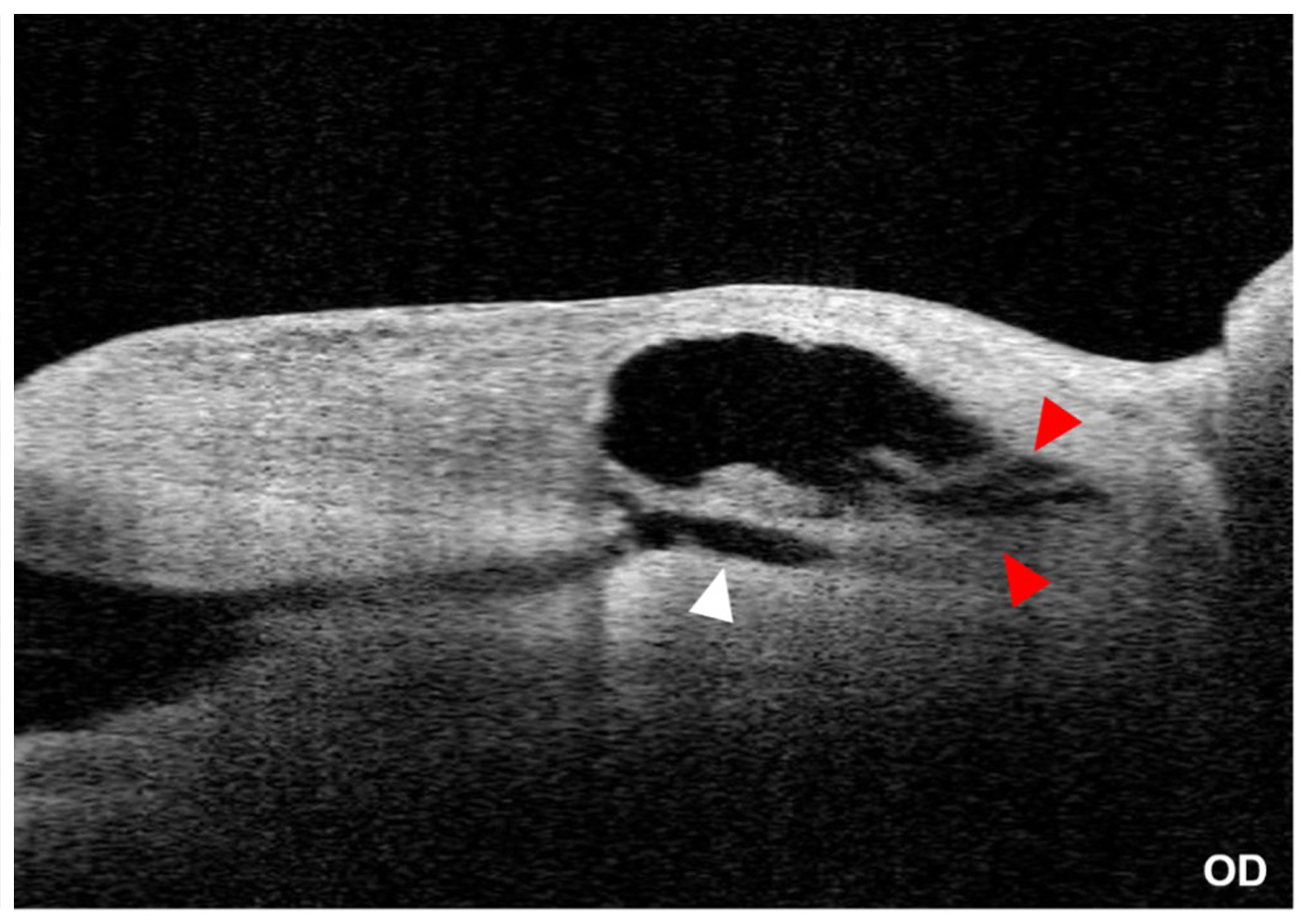 XEN® Gel Stent* Glaucoma Surgery  (Post-op 2 years)
