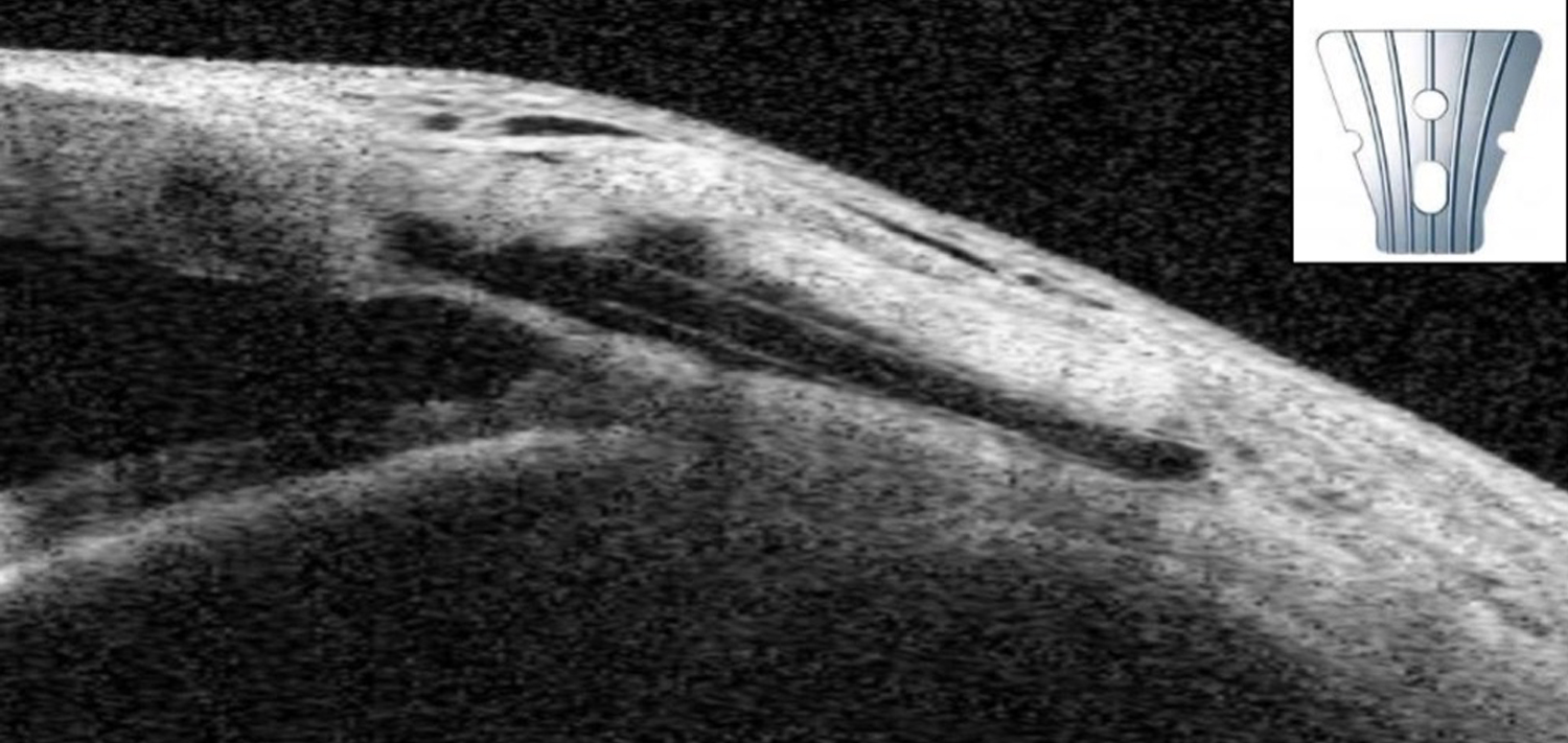 CASIA2 cross-sectional image using “bleb” mode