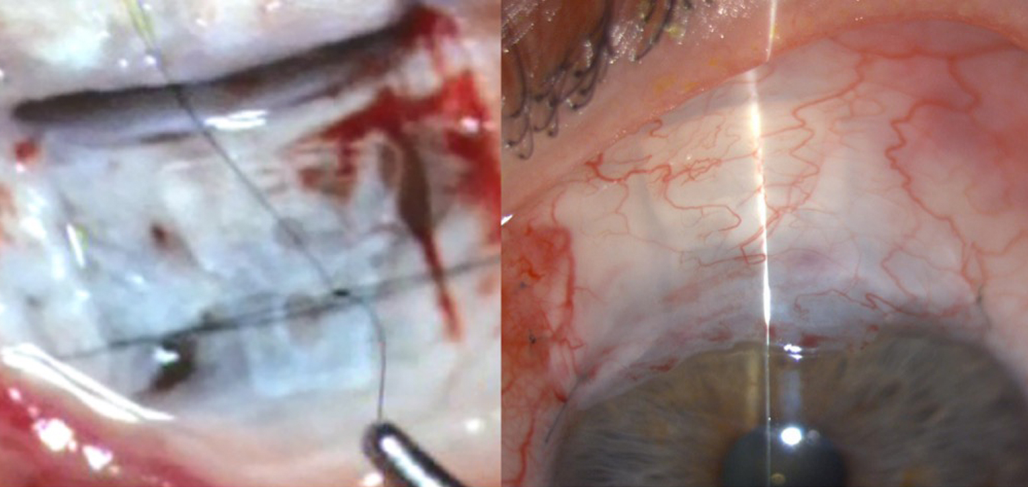 Intraoperative and anterior segment images