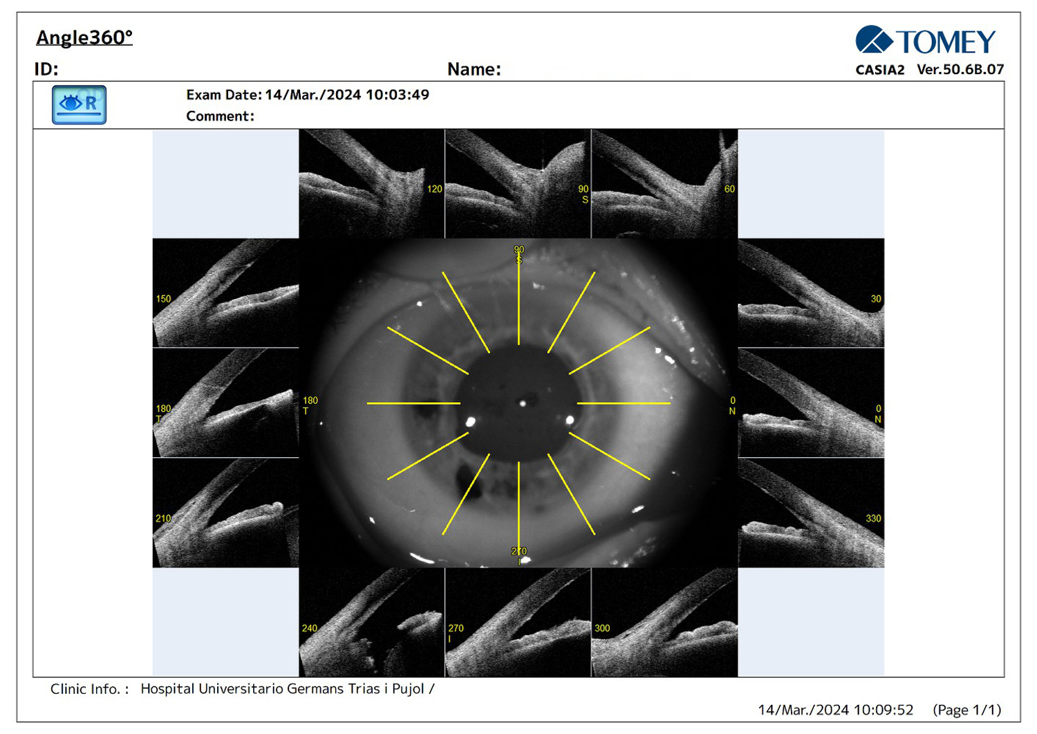 Post-DSAEK Complications and Cataract Surgery  in Fuchs’ Dystrophy