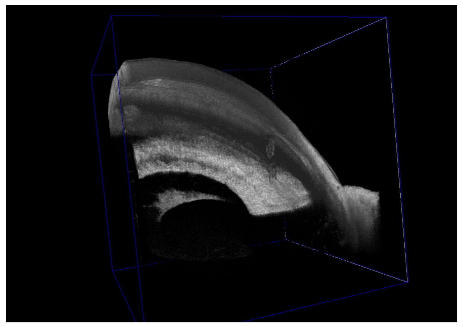 Advanced Imaging of Preserflo Microshunt  in Uveitic Glaucoma Treatment