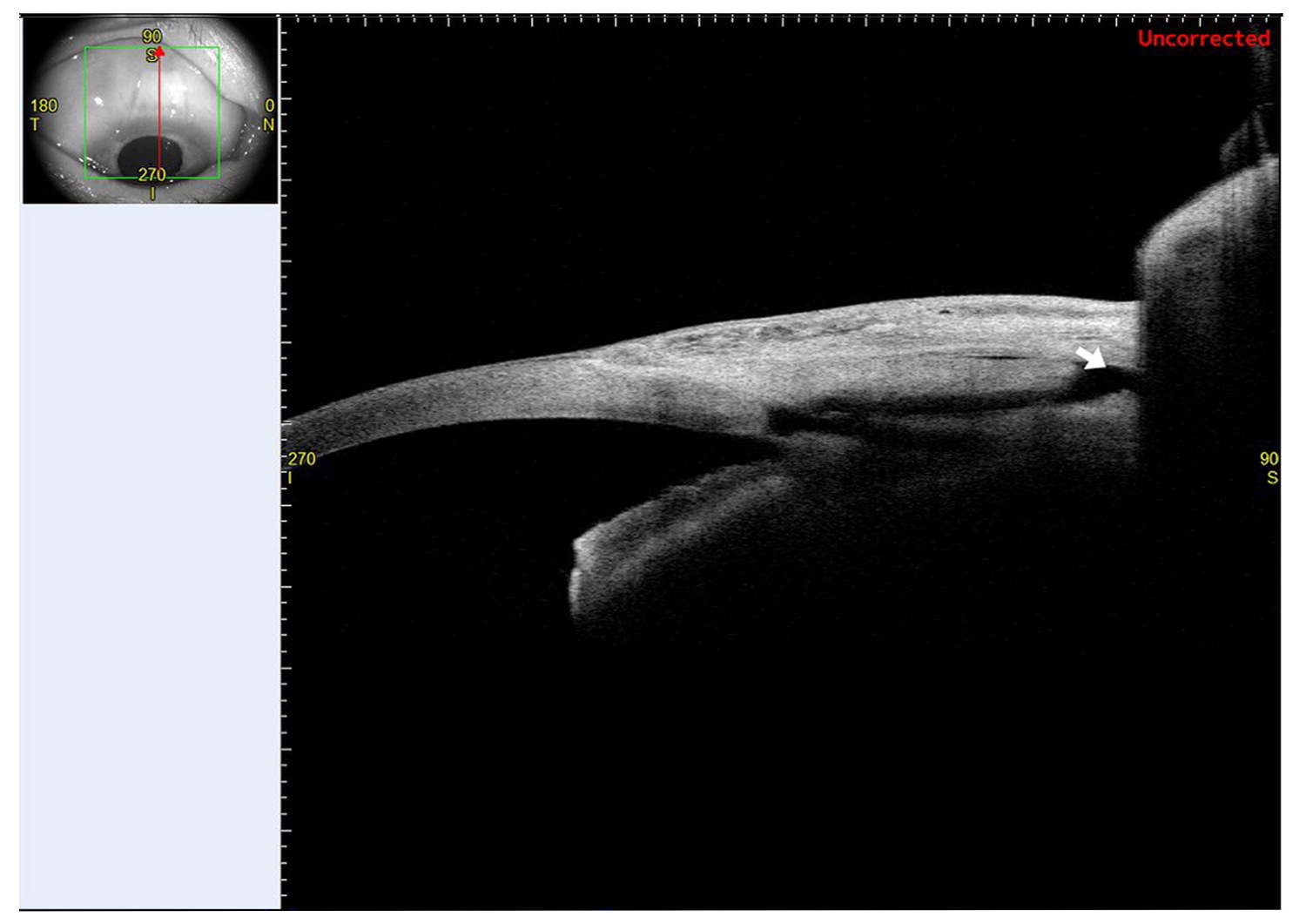 Long-term Success of Esnoper Clip Sclerectomy in Chronic Glaucoma