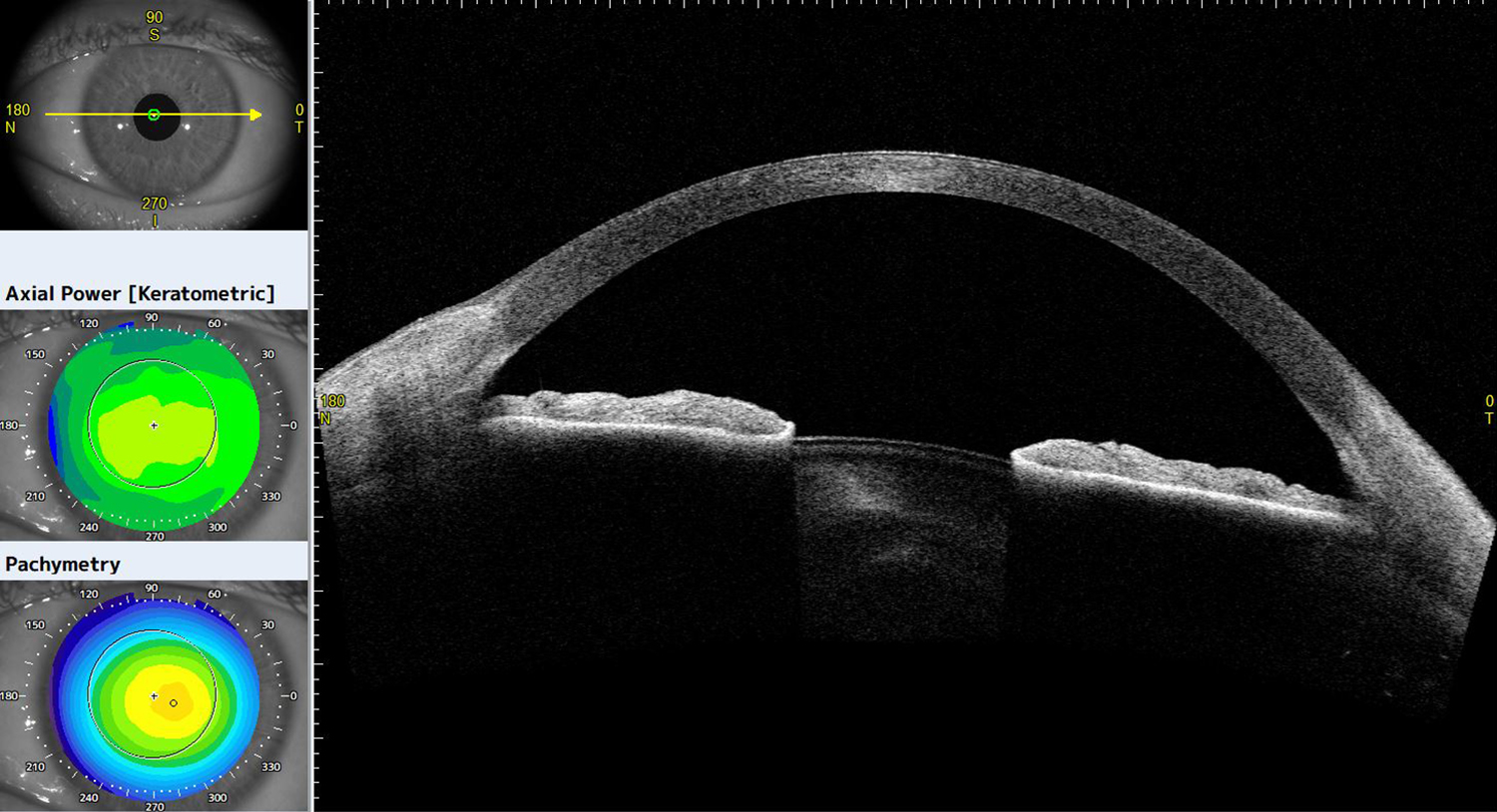 Anterior OCT showing an almost clear cornea after PTK