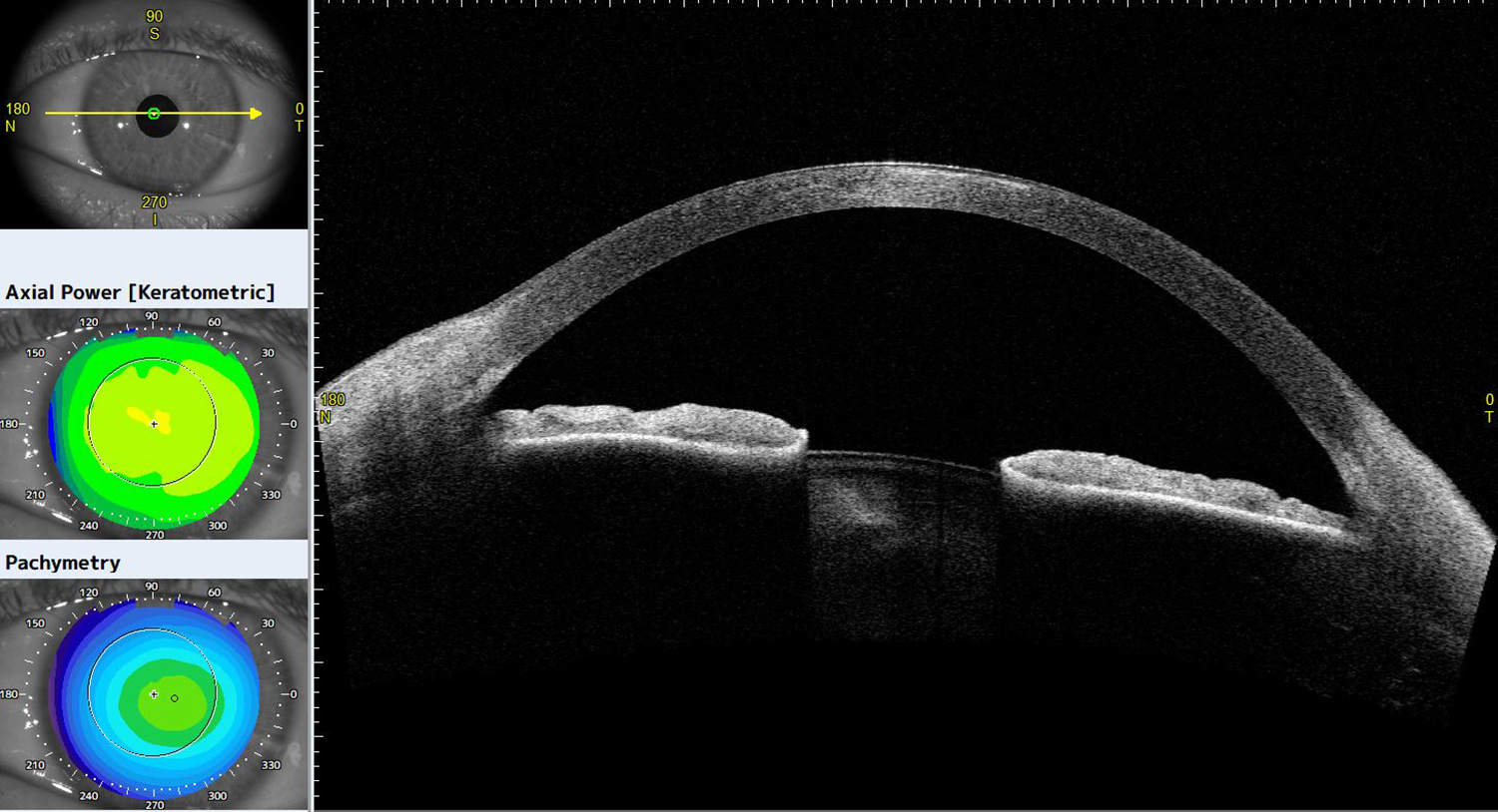Anterior OCT showing a hyperdense area in the anterior corneal stroma prior to PTK