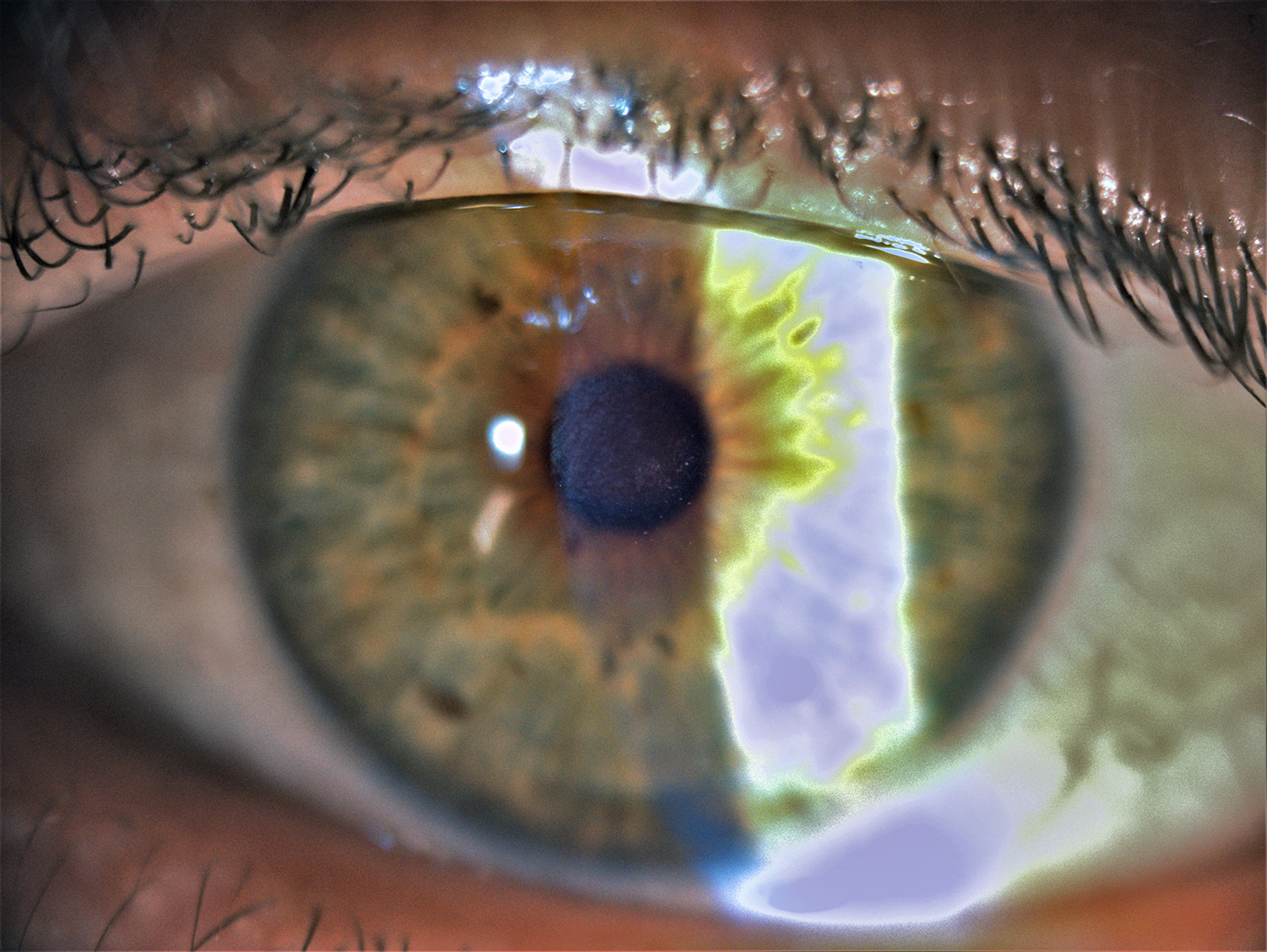 Slit lamp examination revealed almost no residual findings after PTK
