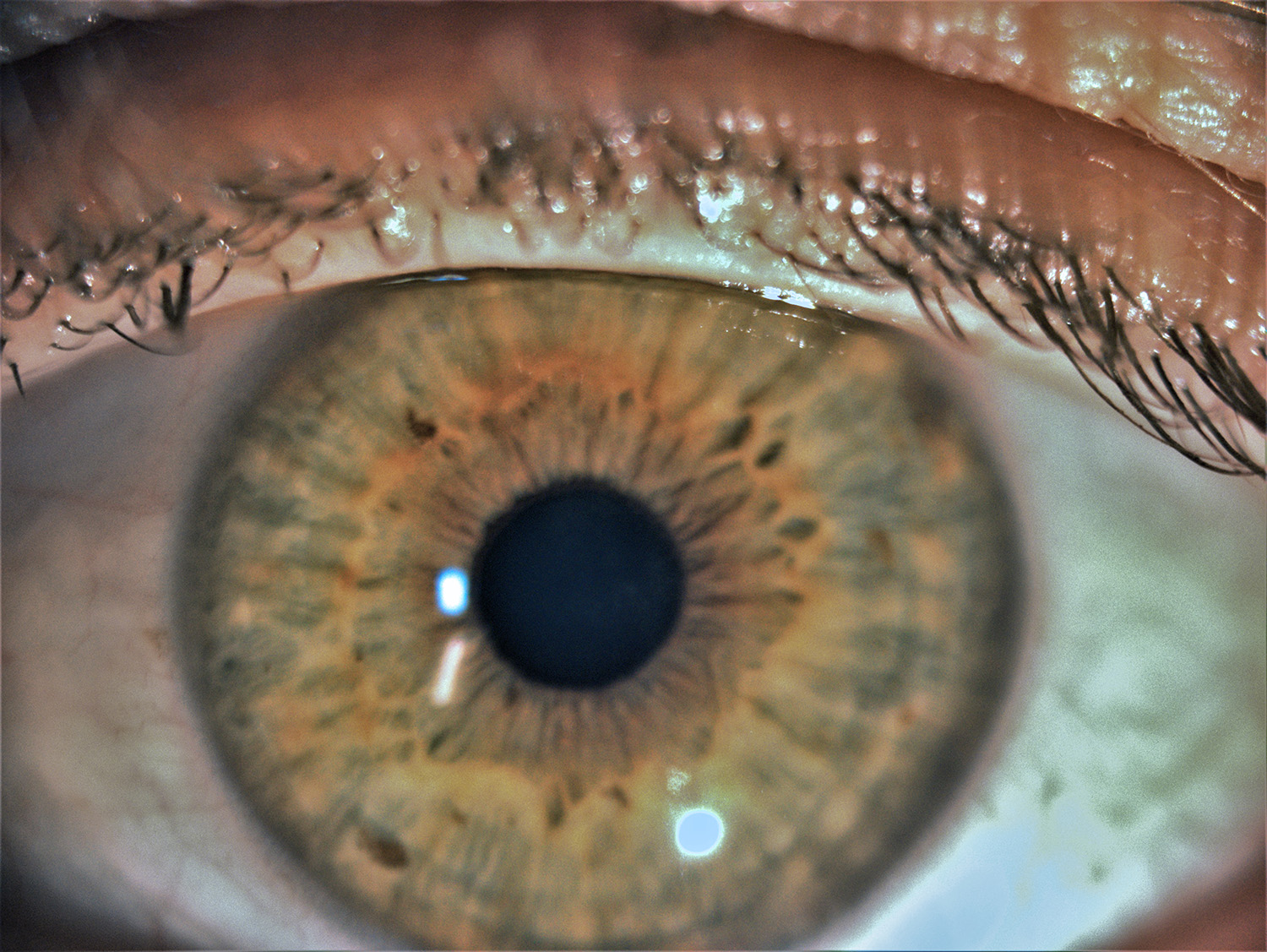 Slit lamp examination revealed almost no residual findings after PTK