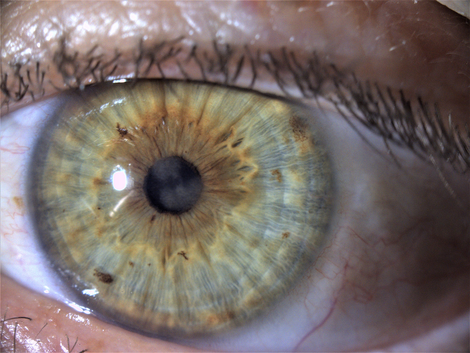 Slit lamp examination shows the corneal scar prior to PTK