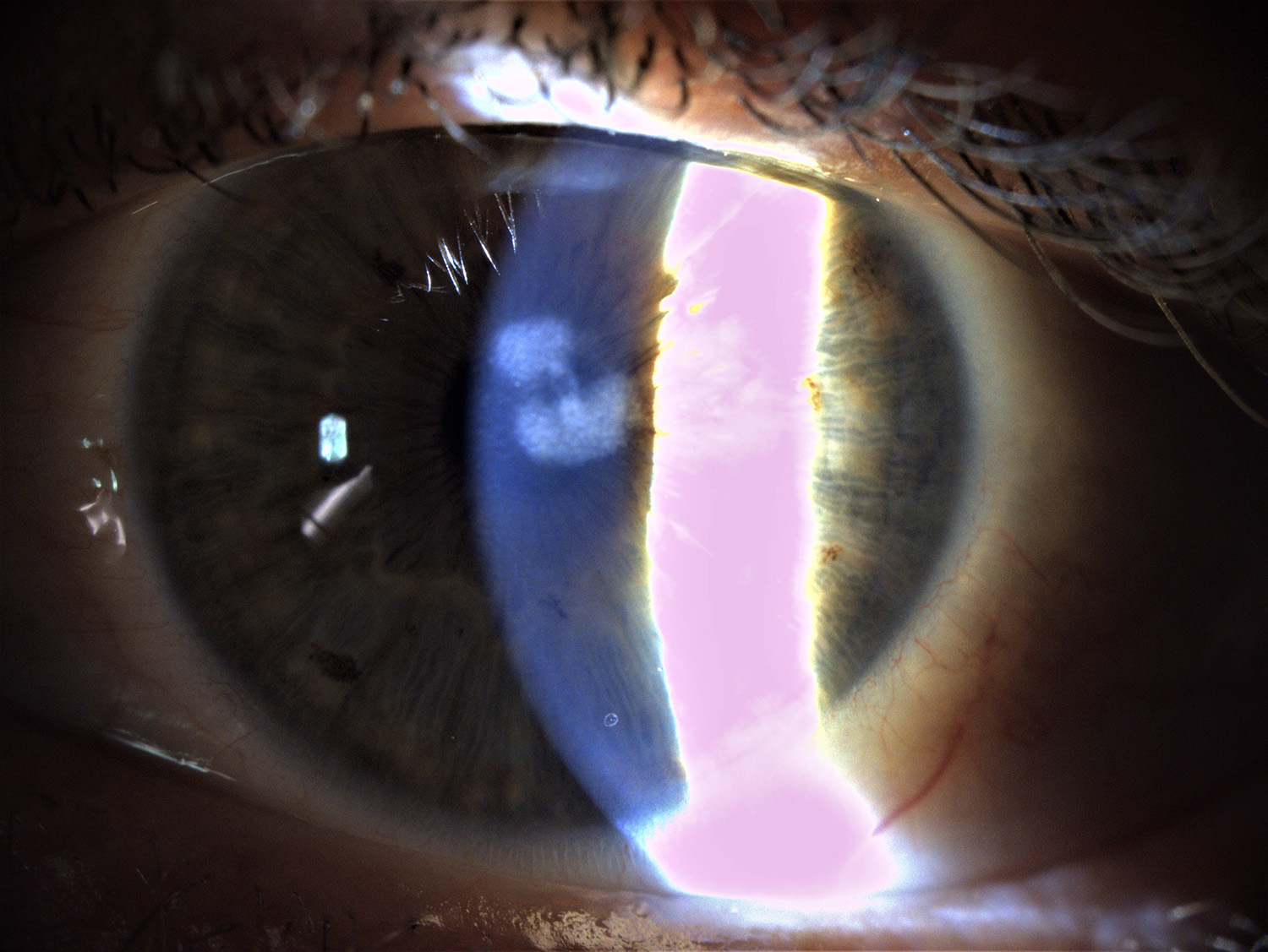 Slit lamp examination shows the corneal scar prior to PTK