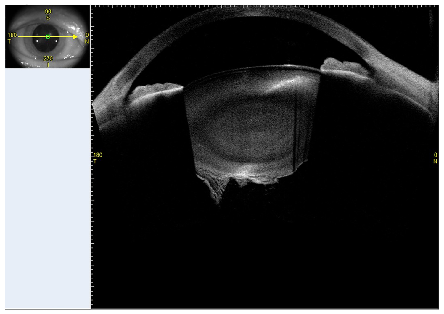 Iatrogenic Injury of the Lens Capsule