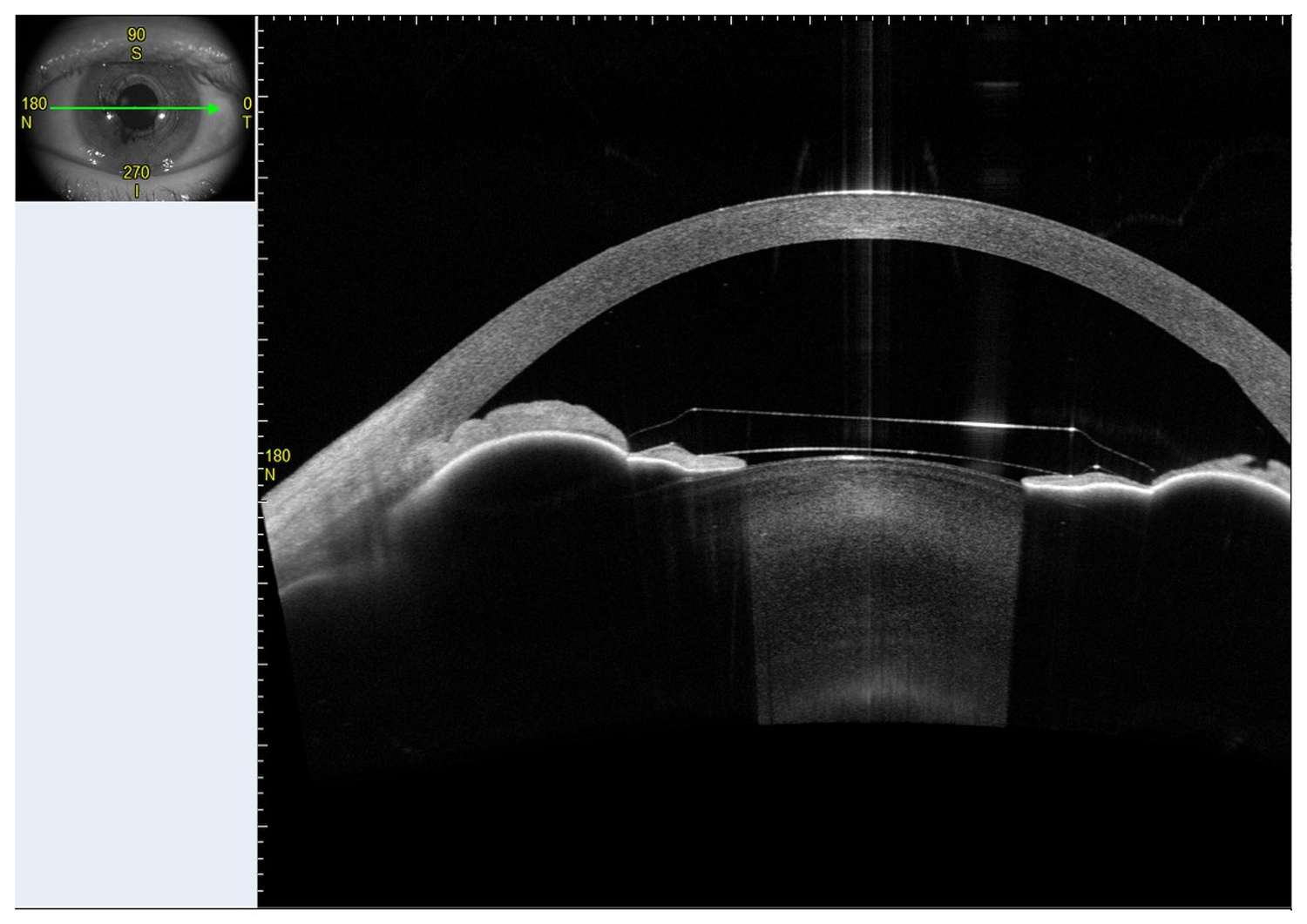Pupillary Block Caused by Phakic Intraocular Lens