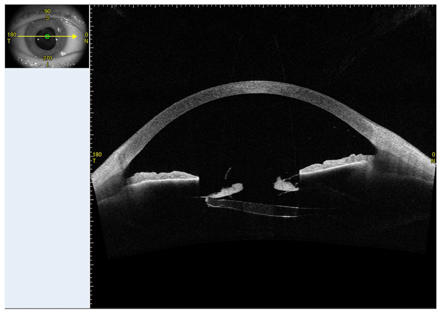 Management of Capsular Bag Phimosis