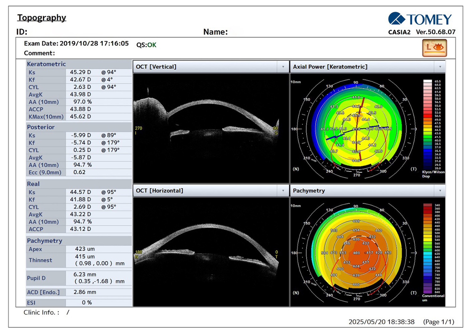 Macular Corneal Dystrophy