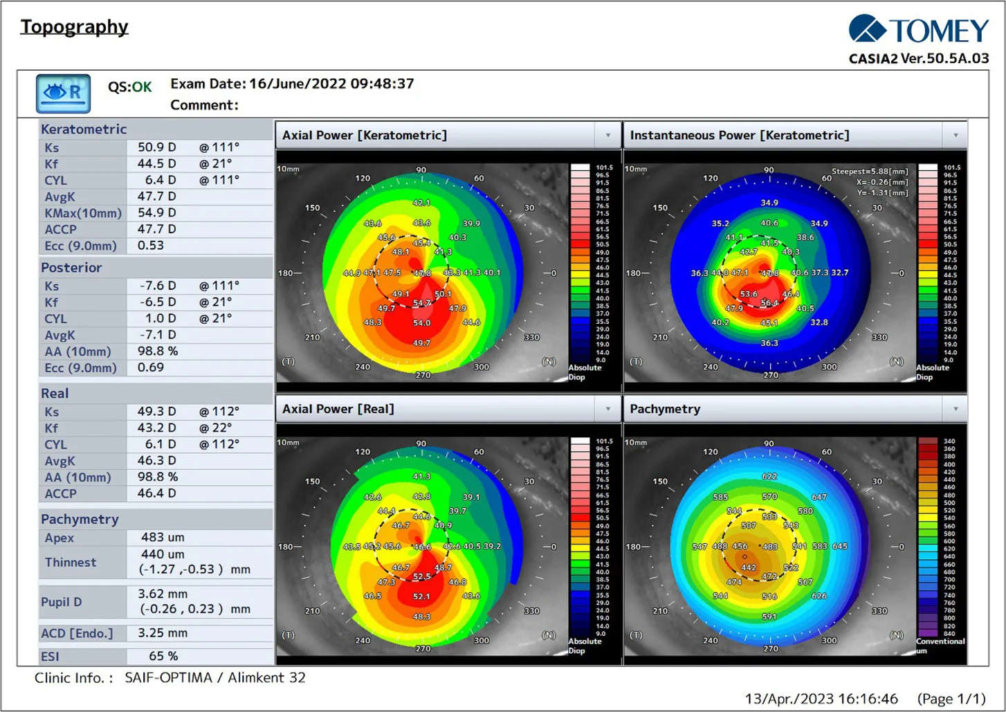 CASIA2 scores before Epi-Off corneal ACXL