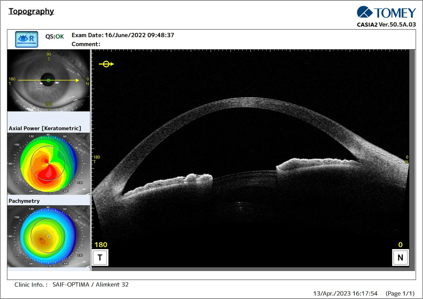 Post-ACXL Corneal Edema in Advanced Keratoconus