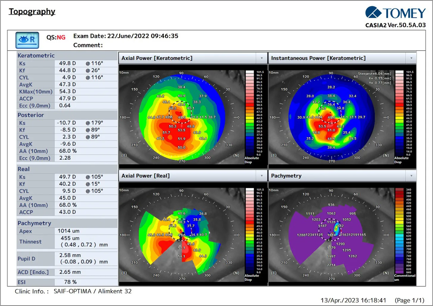 CASIA2 scores on day 1 after Epi-Off corneal ACXL