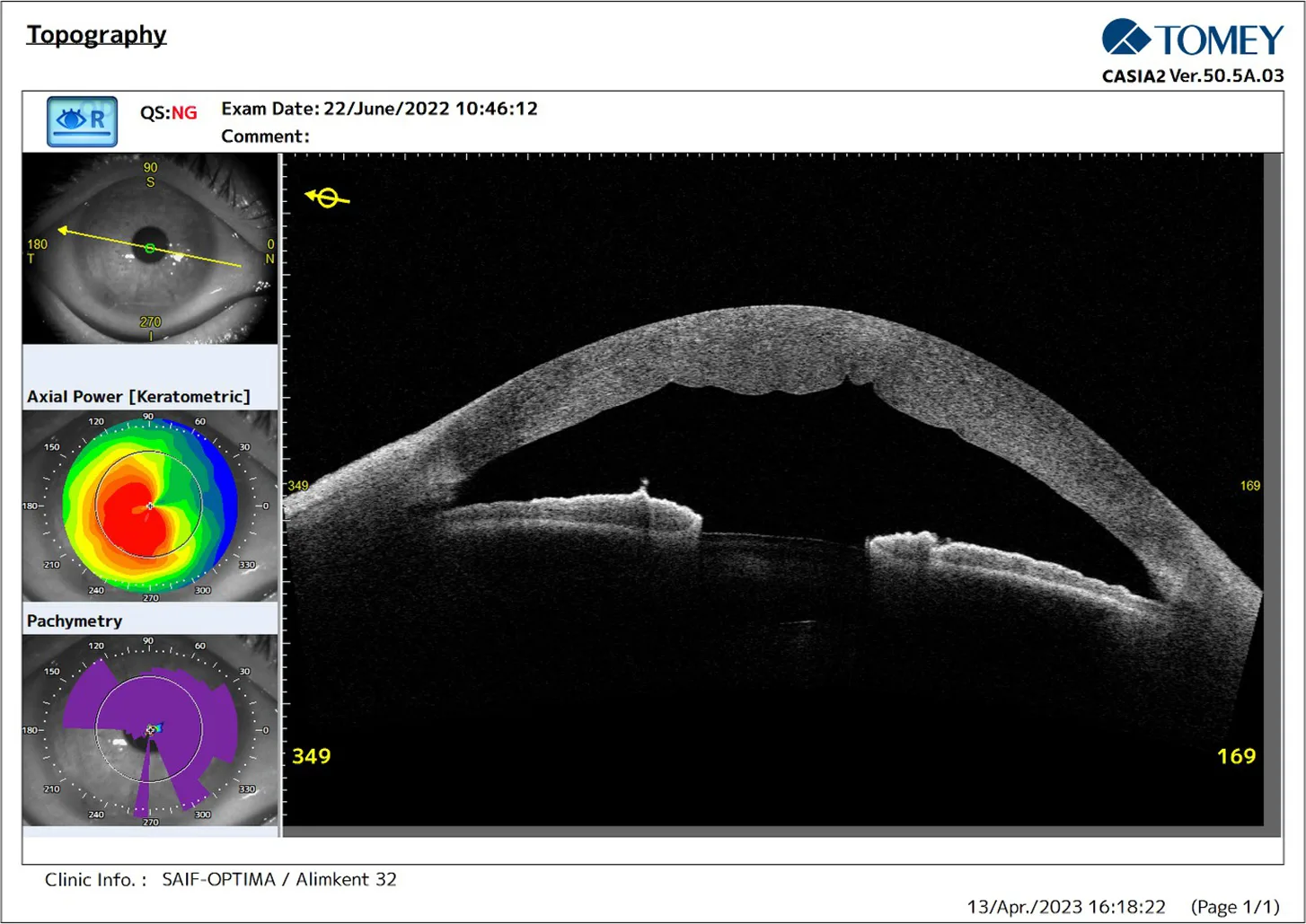 CASIA2 scores on day 1 after Epi-Off corneal ACXL