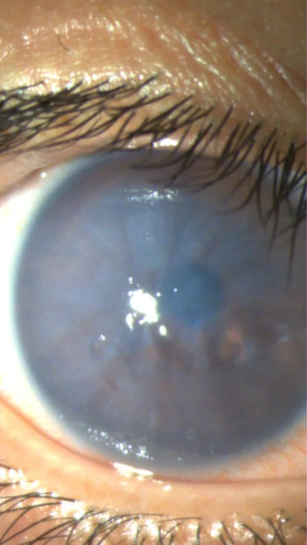 CASIA2 scores on day 1 after Epi-Off corneal ACXL