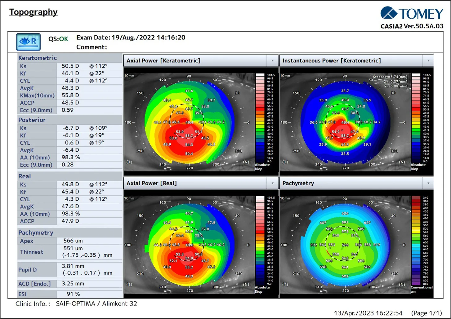 CASIA2 scores 2 months after Epi-Off corneal ACXL